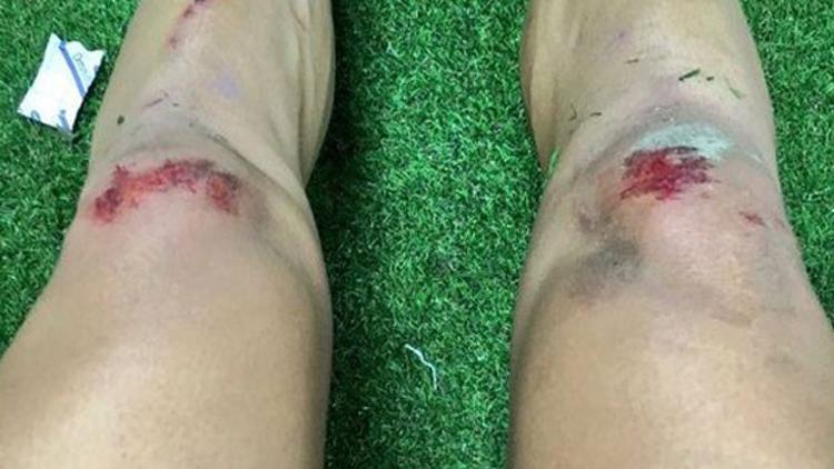 Beşiktaşlı futbolcunun dizleri bu hale geldi