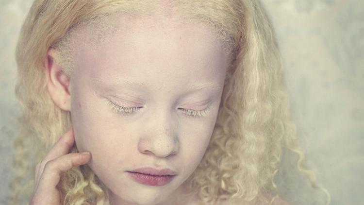 Albino (albinizm) nedir? Albino hastalığı genetik mi?