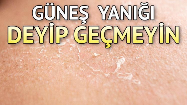 Güneş yanığı nasıl geçer? Güneş yanığına ne iyi gelir?