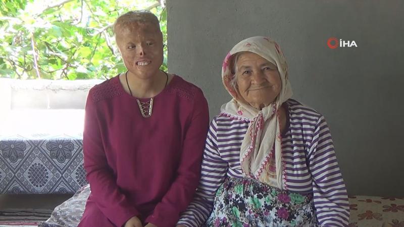 " Leyla yeni "yüzüne" kavuşacağı günü bekliyor